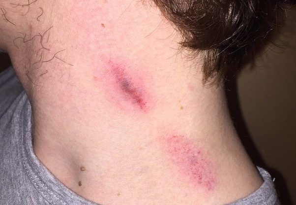 “Chupetón” en el cuello mata a joven en México