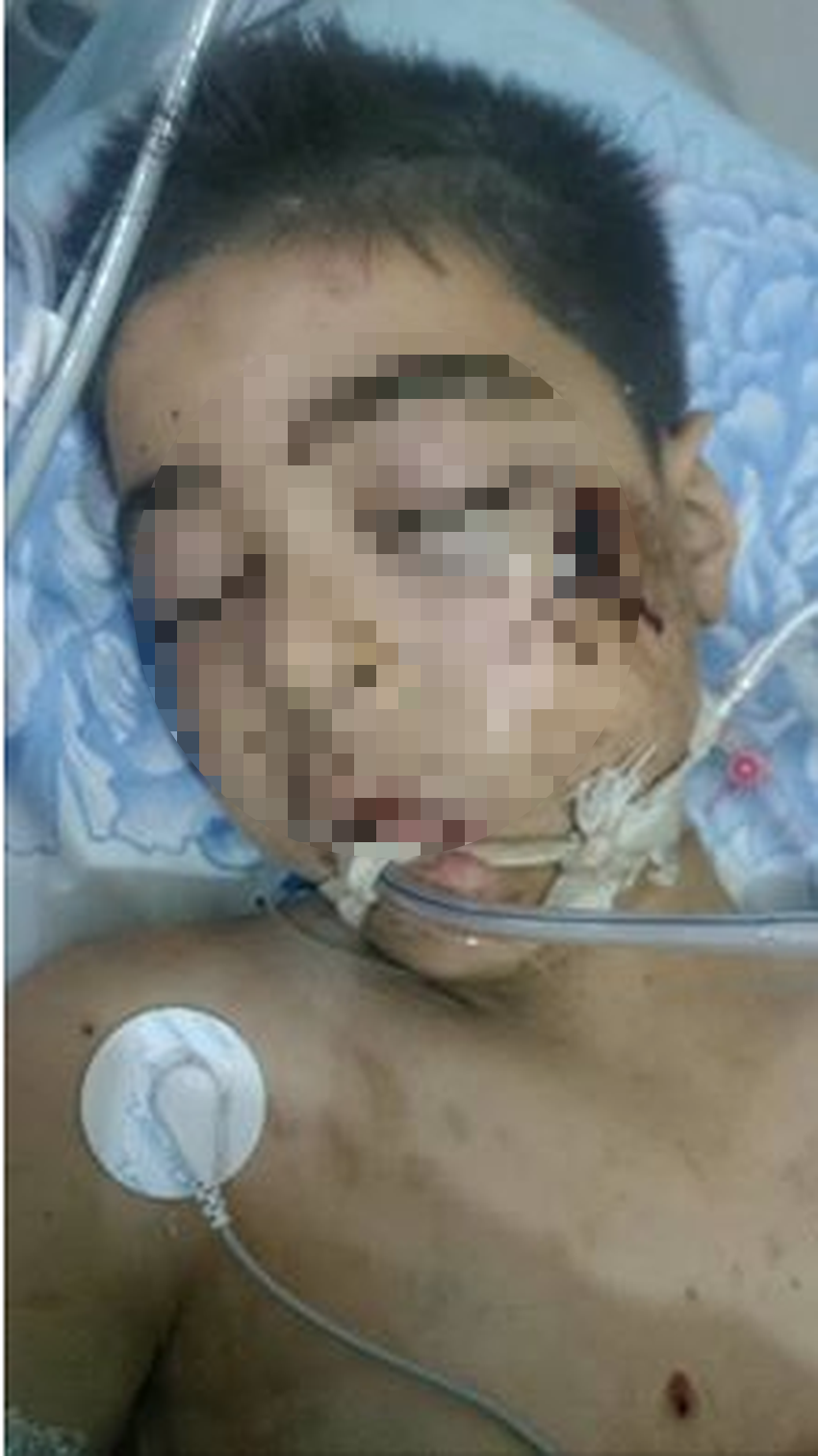 Muere el hermano de Omran Daqneesh, el niño del bombardeo de Alepo - ali-daqneesh