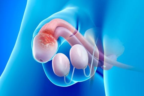 Aumentan los casos de cáncer de pene debido al VPH - cancer-de-pene