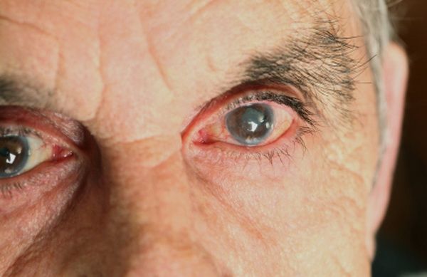 ¿Diabético o hipertenso? Cuida tus ojos y salva tu vida haciendo ejercicio - diabetic_eyes
