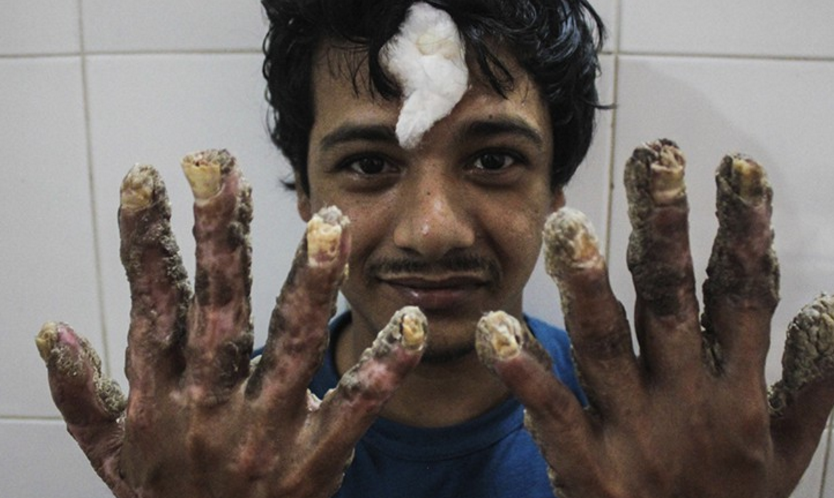 Video: ‘hombre árbol’ recupera sus manos