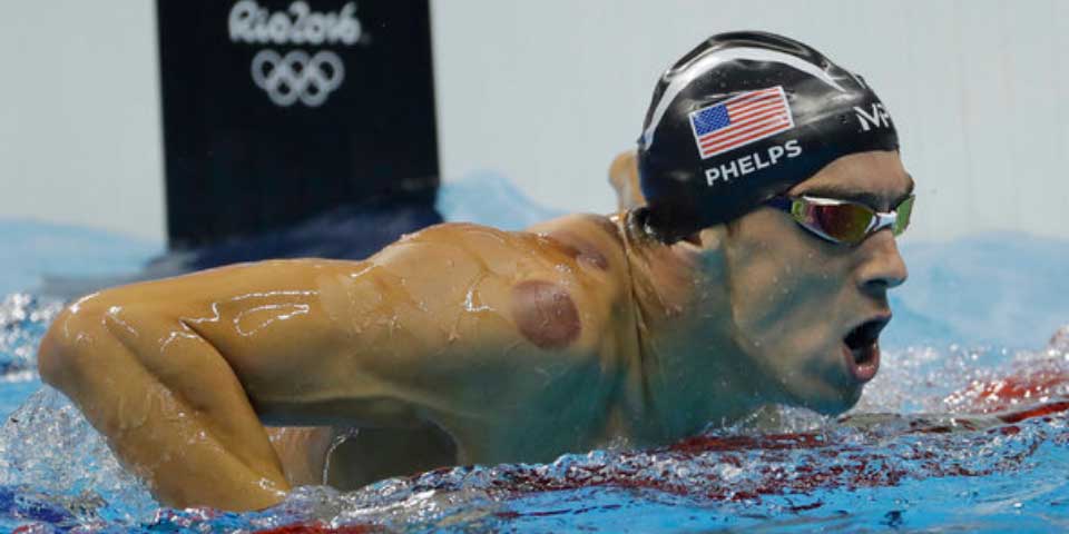¿Qué eran esas marcas moradas en el cuerpo de Michael Phelps? ¿Qué eran esas marcas moradas en el cuerpo de Michael Phelps?