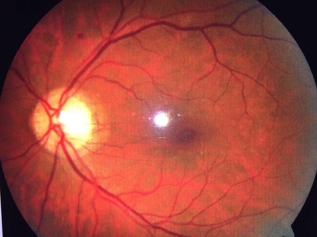 ¿Diabético o hipertenso? Cuida tus ojos y salva tu vida haciendo ejercicio - ojo-1024x768