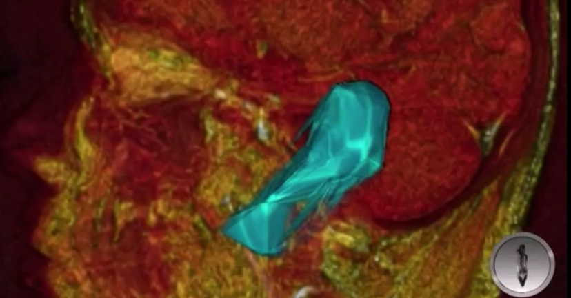 Extraen tumor cerebral del tamaño de pelota de golf en el ISSSTE