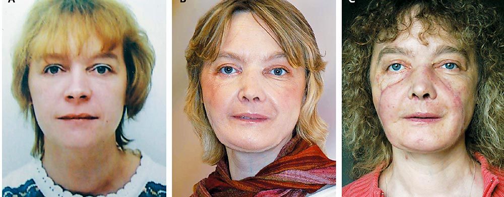 Muere primera paciente de trasplante facial en el mundo