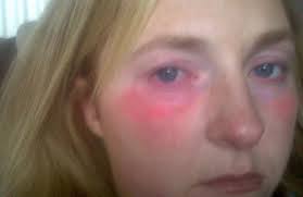 Rachel Warwick, la mujer alérgica al agua - acuagenic-urticaria