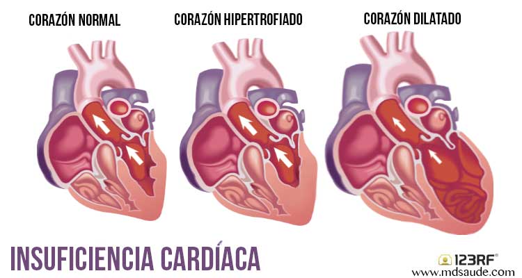 Insuficiencia cardiaca, de las patologías más costosas para Sistema de Salud - cardiaca-2