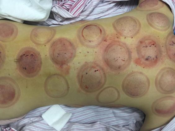 Actriz china muere de cáncer tras elegir tratarse con medicina alternativa - cupping