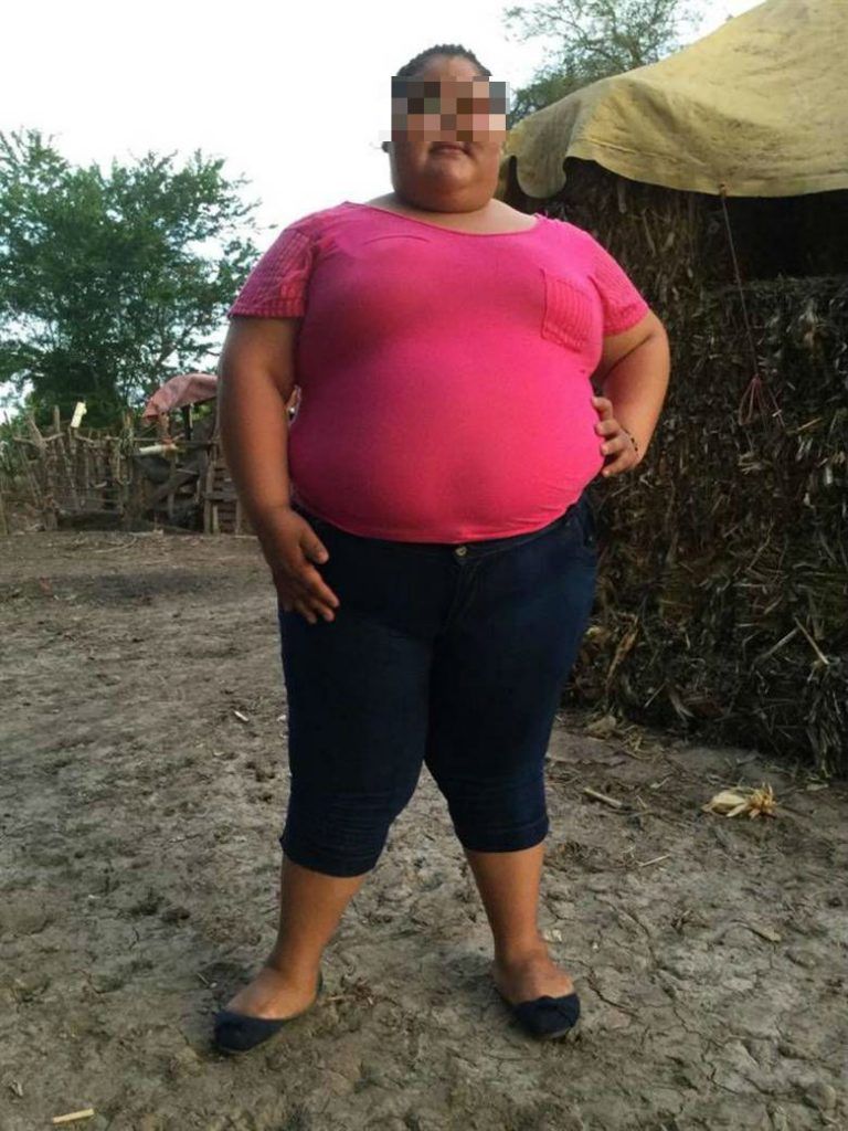 Niña de 14 años y 195 kilos de peso espera que un bypass gástrico le cambie la vida - dayana-camacho-I-1-768x1024