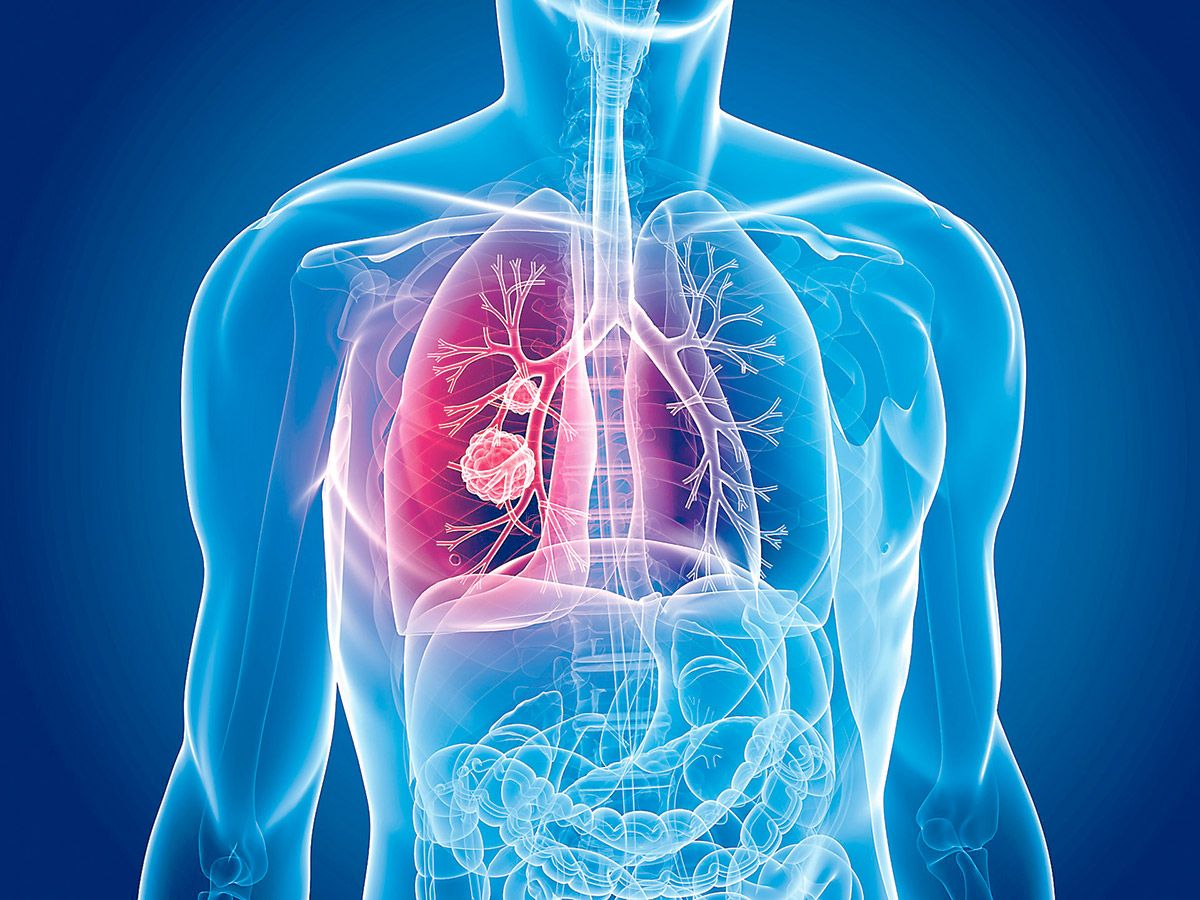 El 88 por ciento de los casos de cáncer de pulmón se detecta en etapa avanzada