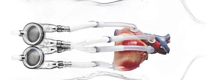 Médicos mexicanos realizan primer implante de corazón artificial - N54040F0G