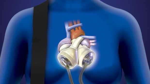 Médicos mexicanos realizan primer implante de corazón artificial