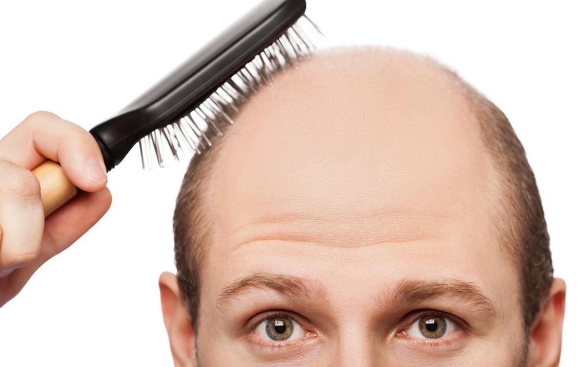 Dietas estrictas pueden provocar alopecia - calvicie-2