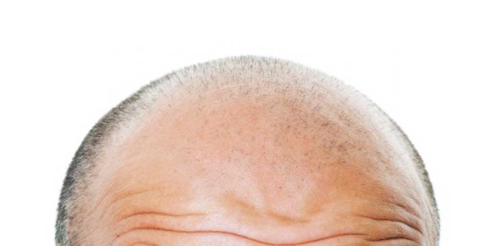 Impresión 3D podría ser la cura de la calvicie