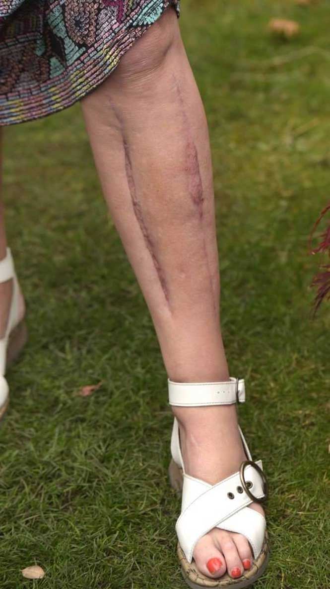 Mujer casi pierde las piernas por utilizar jeans ajustados - jeans