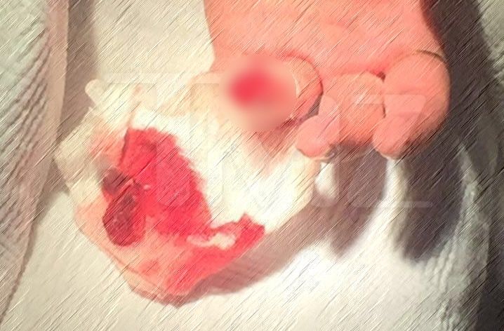 Lindsay Lohan pierde la mitad del dedo en accidente - lindsay-lohan