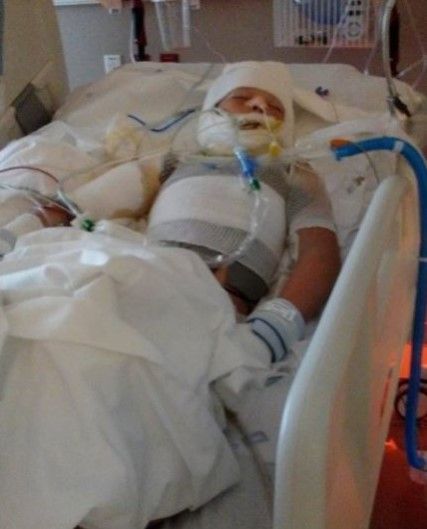 Acusan a menor de quemar a un niño de 10 años en Texas - niño-quemado