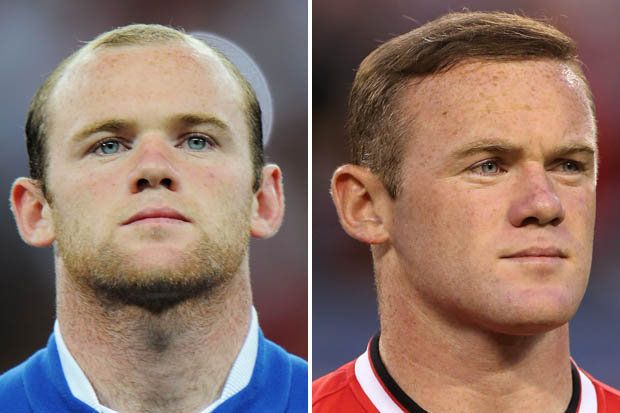 Impresión 3D podría ser la cura de la calvicie - wayne-rooney