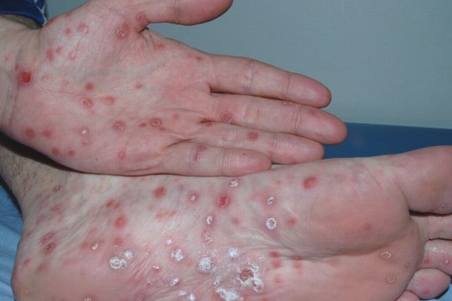 Gonorrea y sífilis son las enfermedades sexuales con mayor repunte en México - 70d872992296c2761f03f4627362cde1-640_427