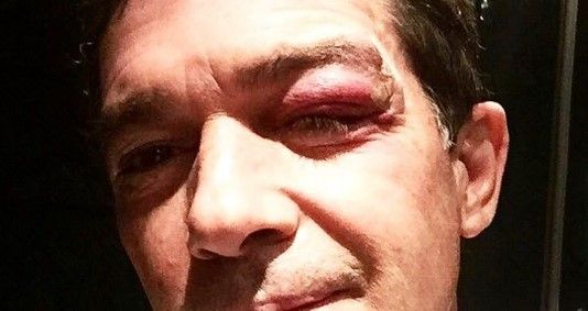 Antonio Banderas presume ojo morado