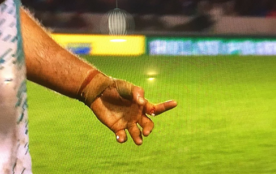 Video: la fractura de un jugador de rugby - james-horwill