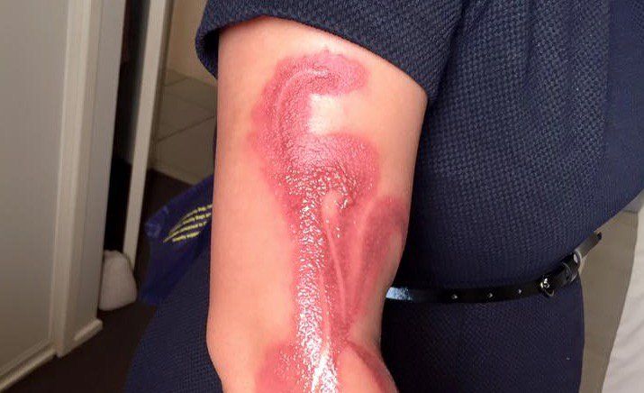 iPhone 7 provoca quemaduras de segundo grado a mujer en Australia