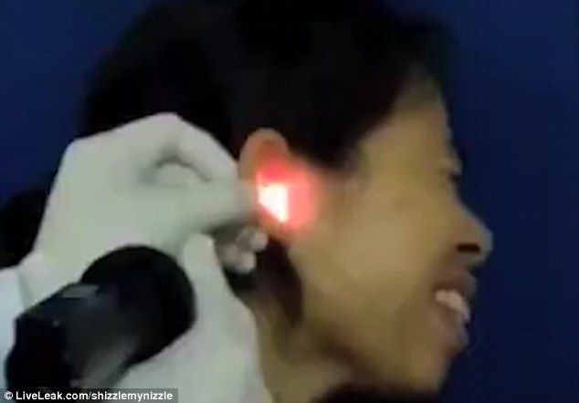 Video: extraen cucaracha de oído de mujer