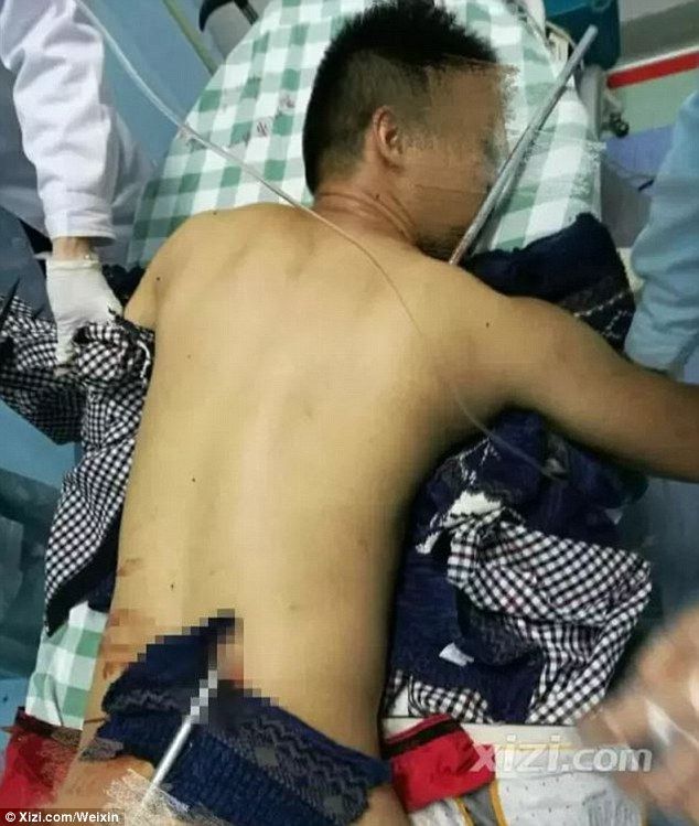 Pararrayos atraviesa a hombre del hombro hasta la cintura en China - pararrayos-china-2