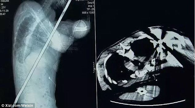 Pararrayos atraviesa a hombre del hombro hasta la cintura en China - pararrayos-china-3