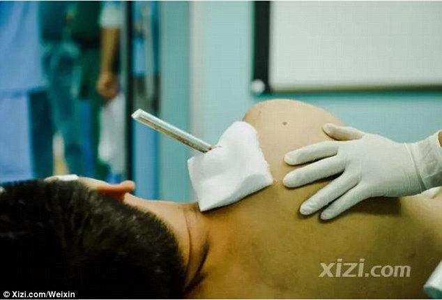 Pararrayos atraviesa a hombre del hombro hasta la cintura en China Pararrayos atraviesa a hombre del hombro hasta la cintura en China