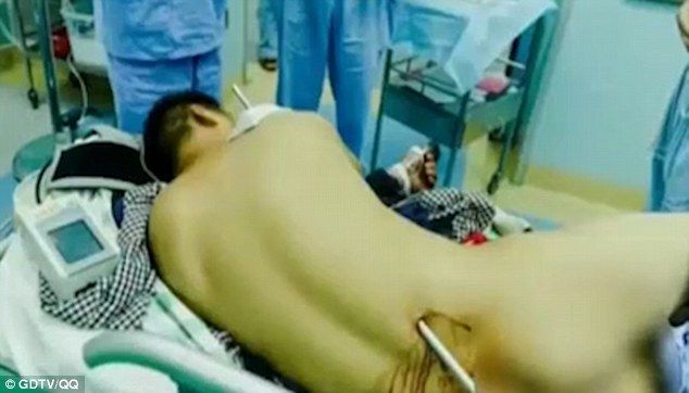 Pararrayos atraviesa a hombre del hombro hasta la cintura en China - pararrayos-china