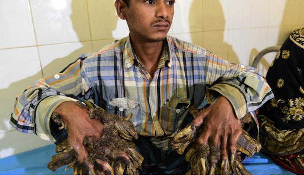 “Ya puedo abrazar a mi hija”: "Hombre Árbol" de Bangladesh - Captura-de-pantalla-2017-01-06-a-las-15.00.13