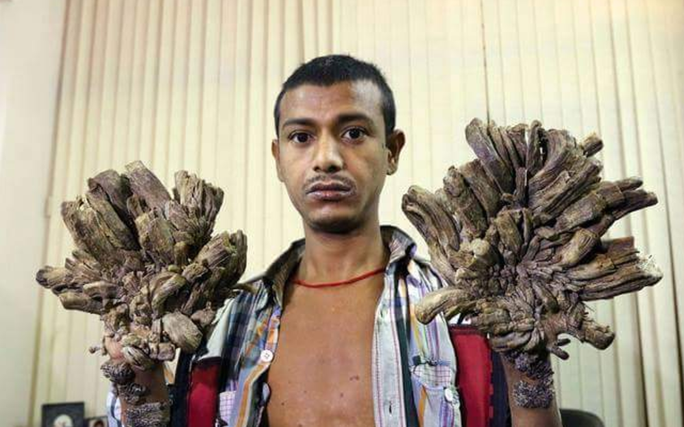 “Ya puedo abrazar a mi hija”: “Hombre Árbol” de Bangladesh