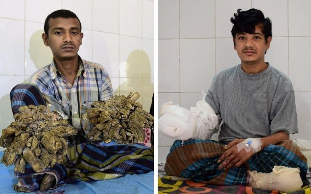 “Ya puedo abrazar a mi hija”: "Hombre Árbol" de Bangladesh - Treeman-composite-image-large_trans_NvBQzQNjv4BqqVzuuqpFlyLIwiB6NTmJwfSVWeZ_vEN7c6bHu2jJnT8