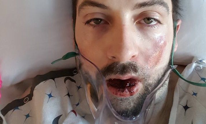 Hombre pierde siete dientes tras explotarle cigarro electrónico