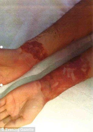 Multan a KFC por quemaduras en dos empleados - quemaduras-kfc