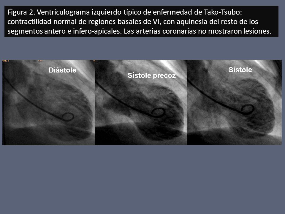 Es posible morir de un corazón roto - slide_7