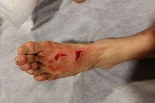 Cortes en el pie de Héctor Herrera tras entrada de Stephan Lichsteiner - héctor-herrera-e1487871447241