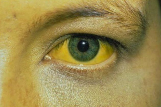 Reportan primera muerte por fiebre amarilla en Río de Janeiro - fiebre-ama-e1489610044736