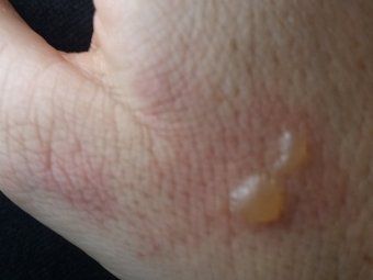 Explotan audífonos durante vuelo - foto-ampolla-mano-australia