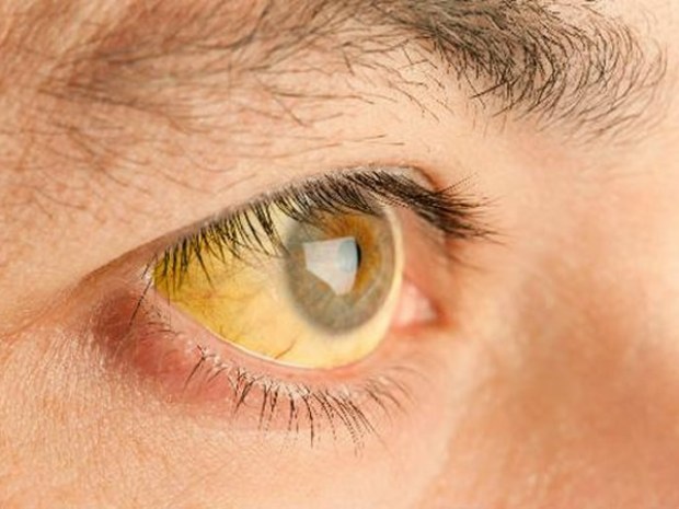 Advierten sobre posible contagio de hepatitis A en albercas insalubres - hepatitis-a