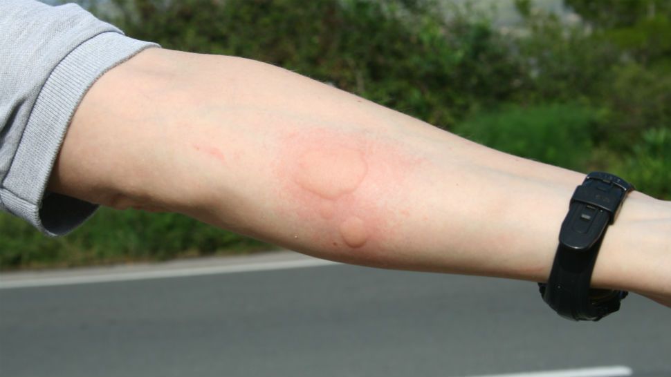 Alertan por picadura de alacranes en Guanajuato - picaduras