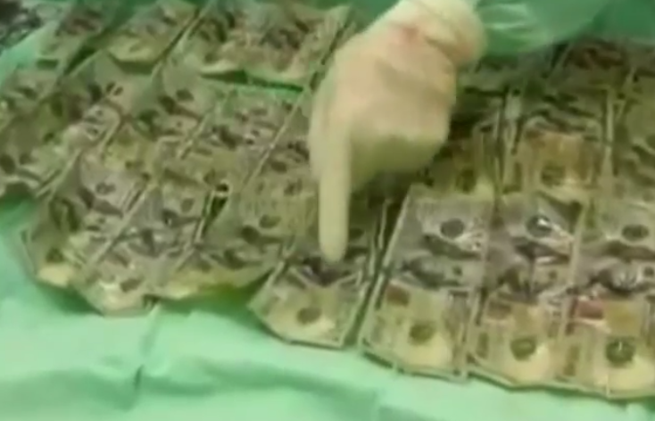 Extraen siete mil dólares del estómago de una mujer - billetes-mujer-colombia