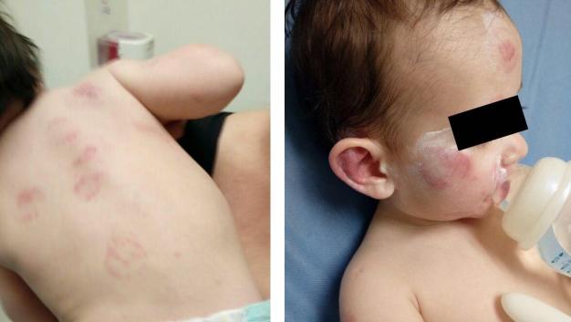 Directora de guardería admite negligencia por niño mordido 25 veces