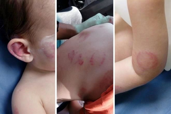 Directora de guardería admite negligencia por niño mordido 25 veces - guardería