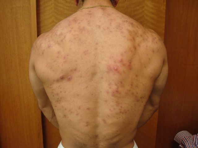 Abusar de la Vitamina B12 puede causar acné - acne-2