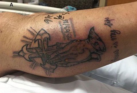 Muere hombre tras infección en tatuaje