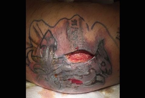 Muere hombre tras infección en tatuaje - tatuaje-infeccion1