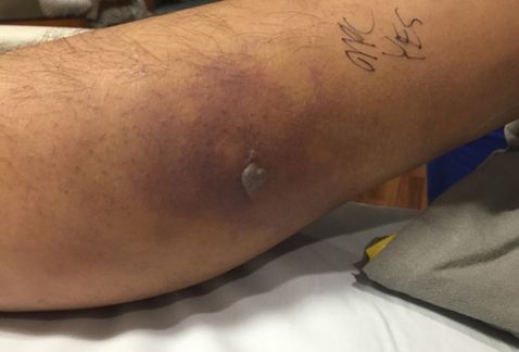 Muere hombre tras infección en tatuaje - tatuaje-infeccion2