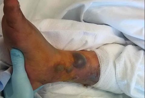 Muere hombre tras infección en tatuaje - tatuaje-infeccion3